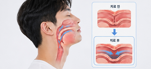 기도확장술