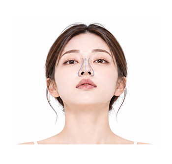 보형물 제거 후 재건이 필요한 경우