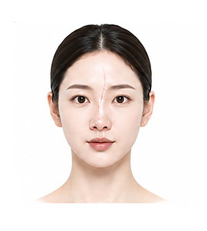 수술 후 코가 휘어보이는 경우